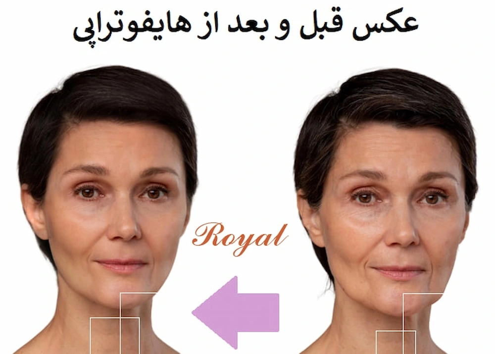 هابفو‌تراپی-در-نازی-آباد-